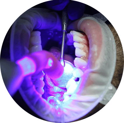 Das Bild zeigt die Behandlung beim Zahnarzt mit Zirkon und verdeutlicht das Thema "Vollkeramik, Zirkon und Komposite für die Füllungstherapie".