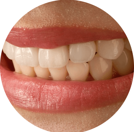 Das Bild zeigt Zähne mit Veneers und dient als Titelbild für das Thema "Keramikveneers zur Zahnverblendung".