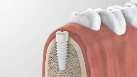 Das Bild zeigt die Implantation der künstlichen Zahnwurzel.