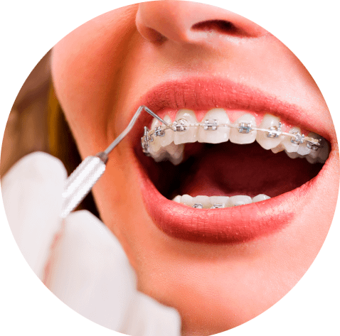 Das Bild zeigt die Kontrolle von Brackets einer Zahnspange und dient als Titelbild für das Thema "Kieferorthopädische Behandlung für Patienten aus Lingen, Meppen, Nordhorn und Umgebung".