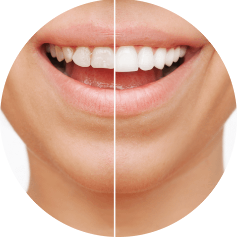 Das Bild zeigt die Frontzähne einer Frau vor und nach einer ästethischen Zahnbehandlung und dient als Beitragsbild für das Thema "Zahnästhetik".
