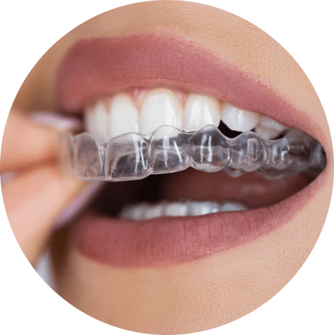 Das Bild zeigt wie eine transparente Zahnschiene im Oberkiefer eingesetzt wird und dient zur Verdeutlichung des Themas "Schienentherapie zur Behandlung verschiedener Symptome".