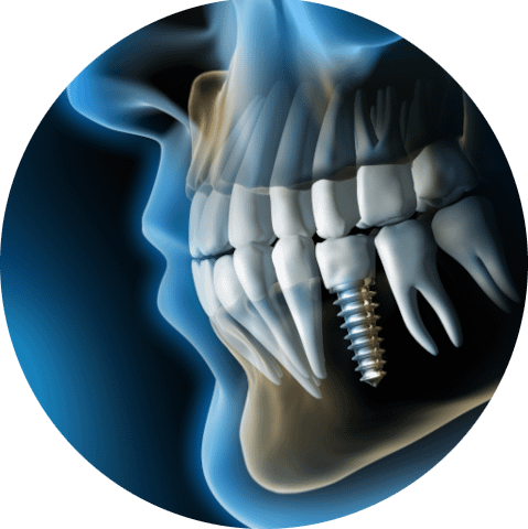 Das Bild zeigt eine 3D-Aufnahme eines Zahnimplantats und dient als Titelbild für das Thema "Implantologie von Titan- und Keramikimplantaten".