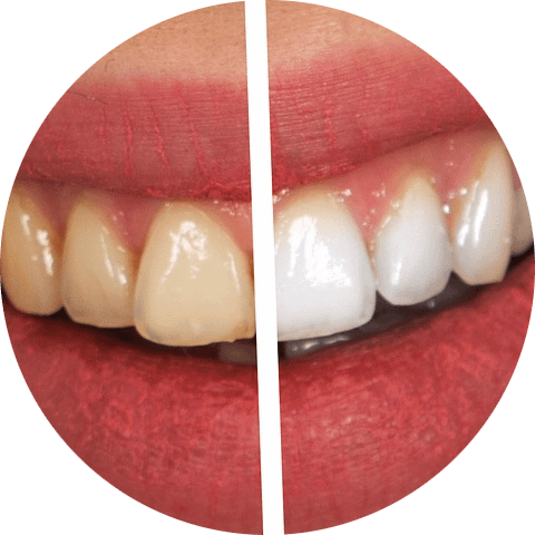 Das Bild zeigt die Zähne einer Frau vor und nach dem Zahnbleaching und dient als Titelbild für das Thema "Zahnaufhellung".