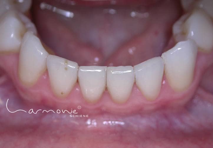 Das Bild zeigt die geraden Zähne nach der Schienentherapie.
