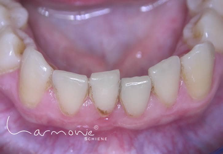 Das Bild zeigt schiefe Zähne vor Schienentherapie.