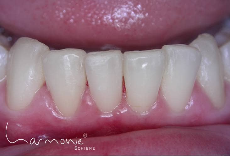 Das Bild zeigt die geraden Zähne nach der Behandlung mit der unsichtbaren Zahnspange.