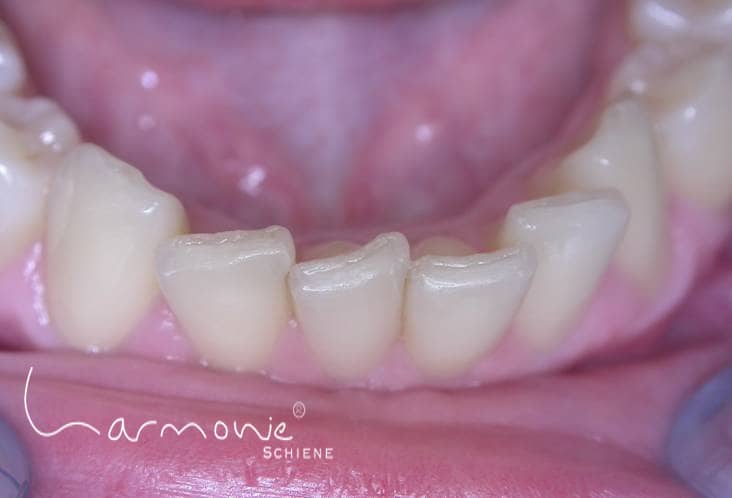 Das Bild zeigt schiefe Zähne vor der Behandlung mit der unsichtbaren Zahnspange.