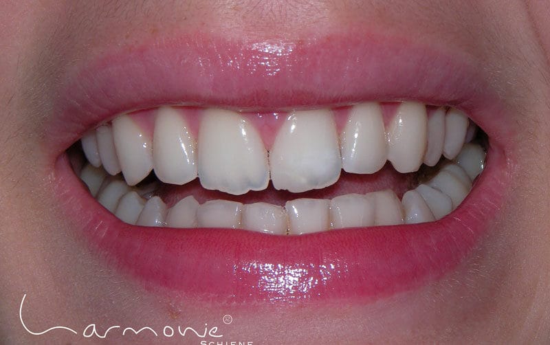Das Bild zeigt die geschlossene Zahnlücke einer Patientin nach der Schienentherapie mit der HarmonieSchiene.