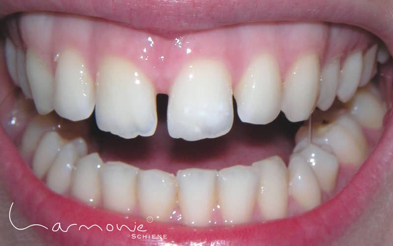 Das Bild zeigt die störende Zahnlücke einer Patientin vor der Schienentherapie mit der HarmonieSchiene.