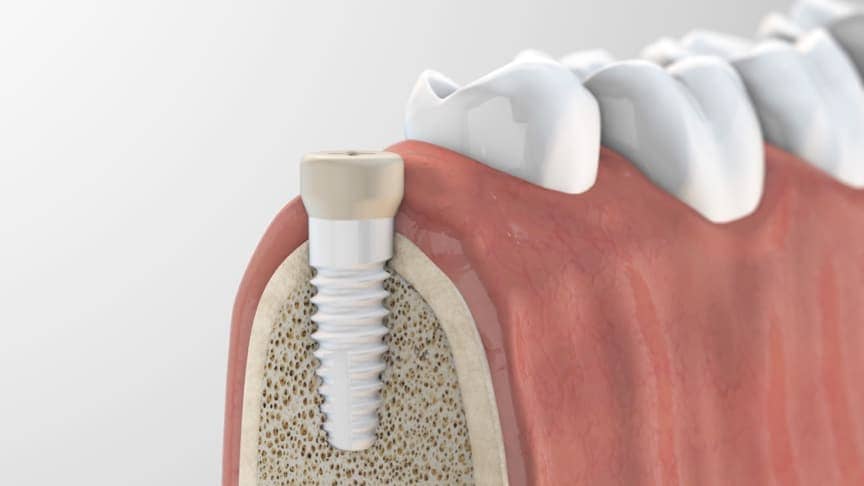 Das Bild zeigt die künstliche Zahnwurzel während der Einheilungsphase und dient als Beitragsbild für das Thema Zahnimplantate.